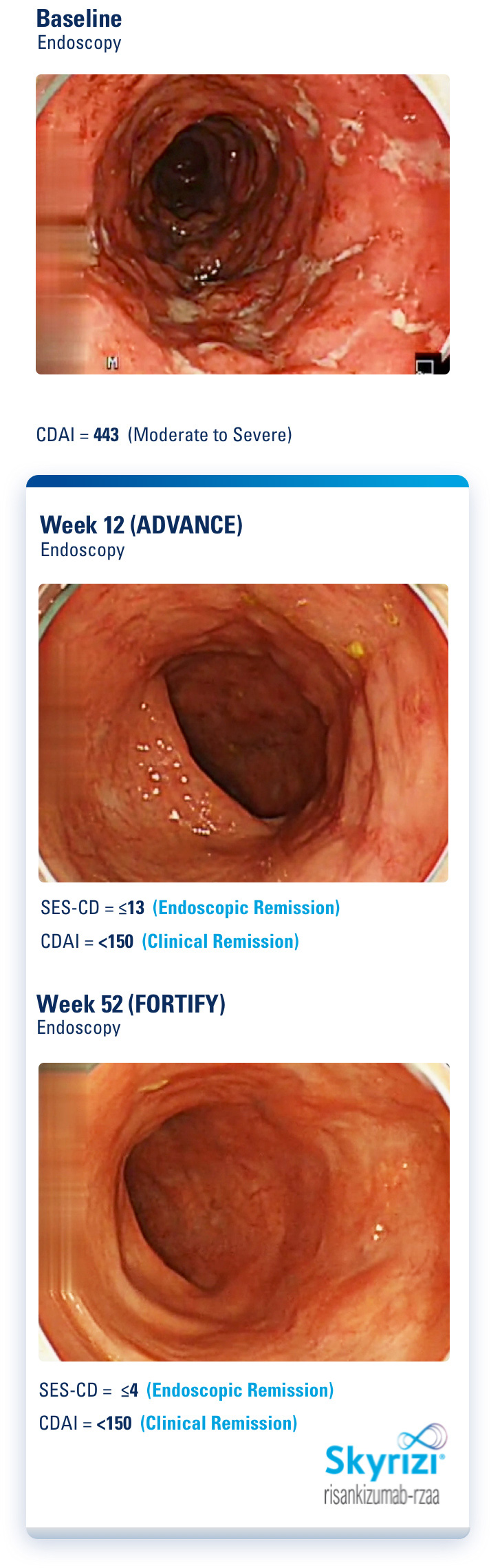 Endoscopy images of a clinical trial patient at baseline, Week 12 and Week 52