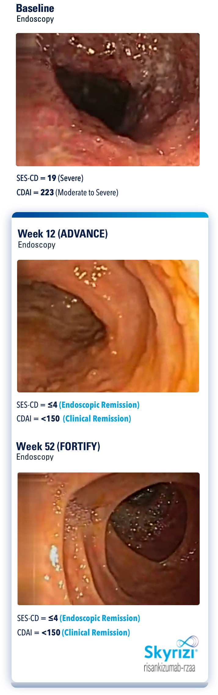Endoscopy images of a clinical trial patient at baseline, Week 12 and Week 52