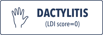Dactylitis (LDI score=0).