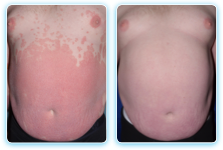 Before and after photos of SKYRIZI®- treated patients with moderate to severe plaque psoriasis from the UltIMMa-2 study with PASI 90 clearance.