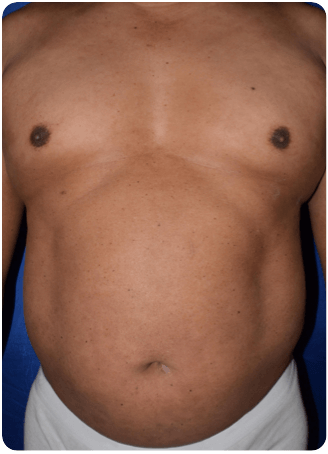 Before and After: 5 doses Week 52 PASI improvement of chest.